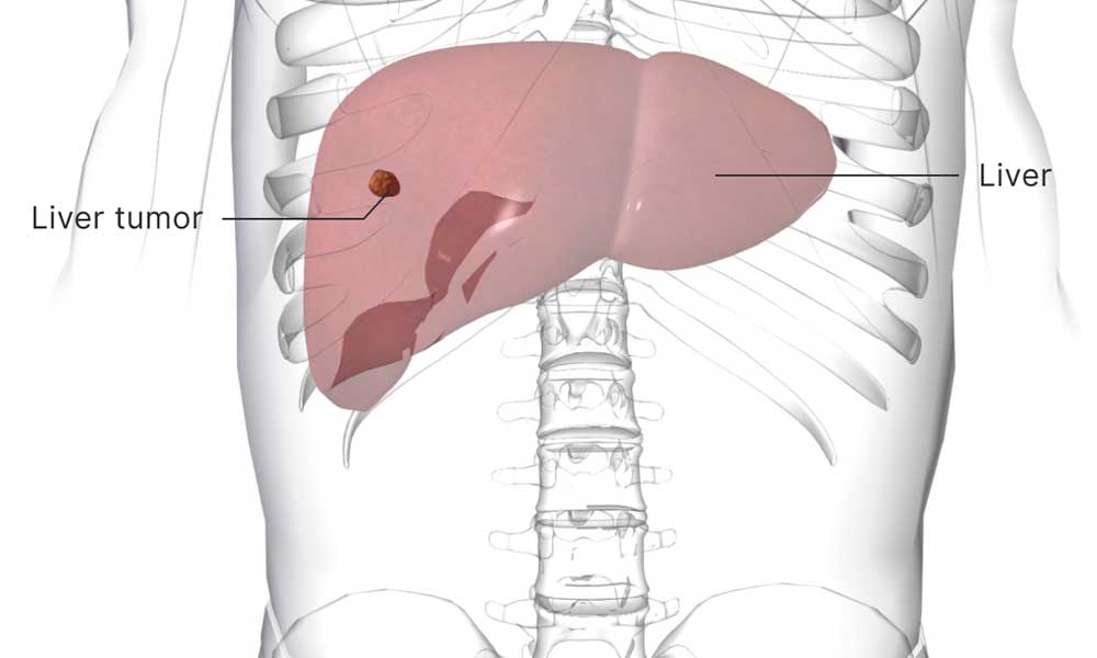 Liver Tumor Treated Non Surgically By Rfa Tace And Tare