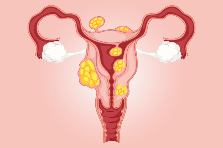 Understanding uterine fibroids symptoms,  treatment options and the benefits of non surgical treatment uterine artery embolization