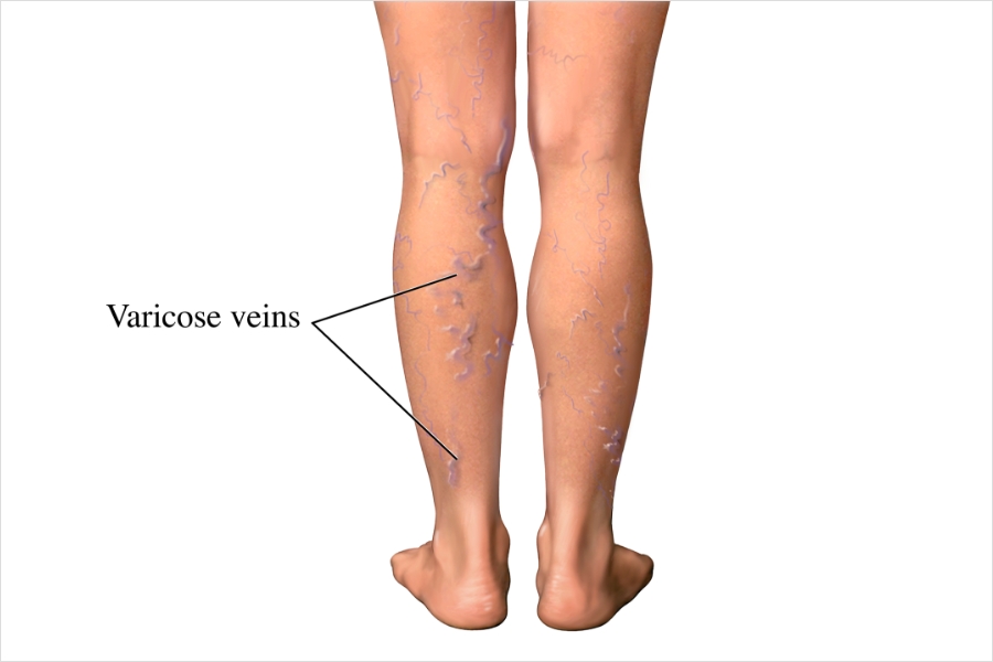 Understanding Varicose Veins: Symptoms, Treatment Options, and the Benefits of Non-Surgical Treatments