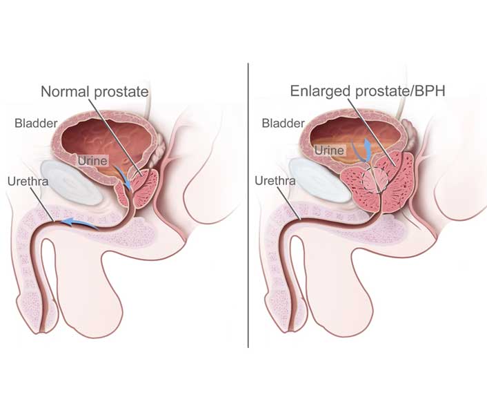 Prostate Enlargement (BPH) - Causes - Symptoms and latest Treatment