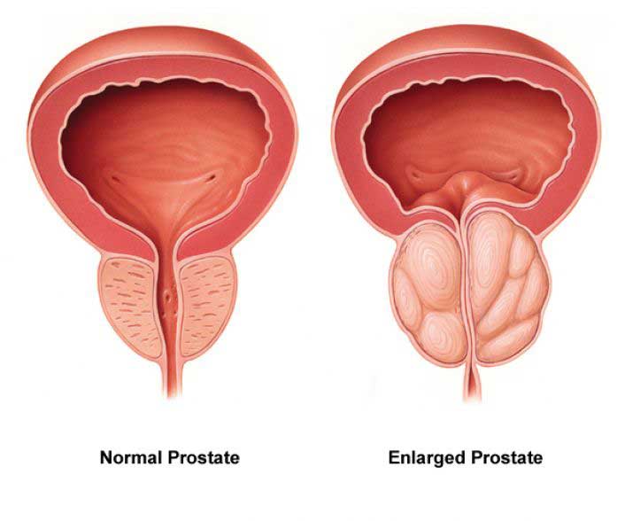Prostate gland enlargement: Complications