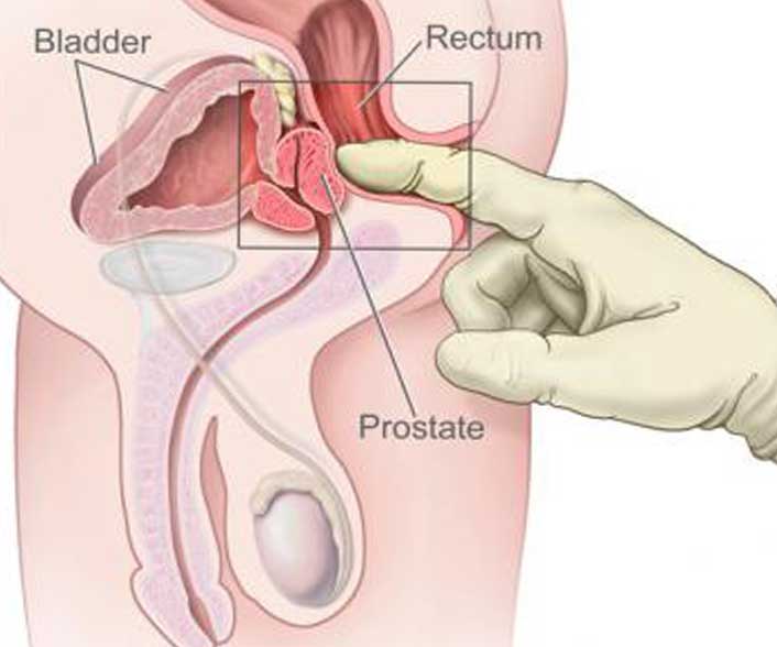 Prostate-Specific Antigen Testing for enlarged Prostate (BPH) and Cancer