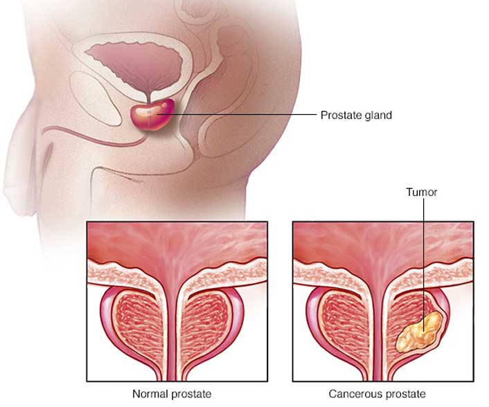 Prostate Cancer (Screening)