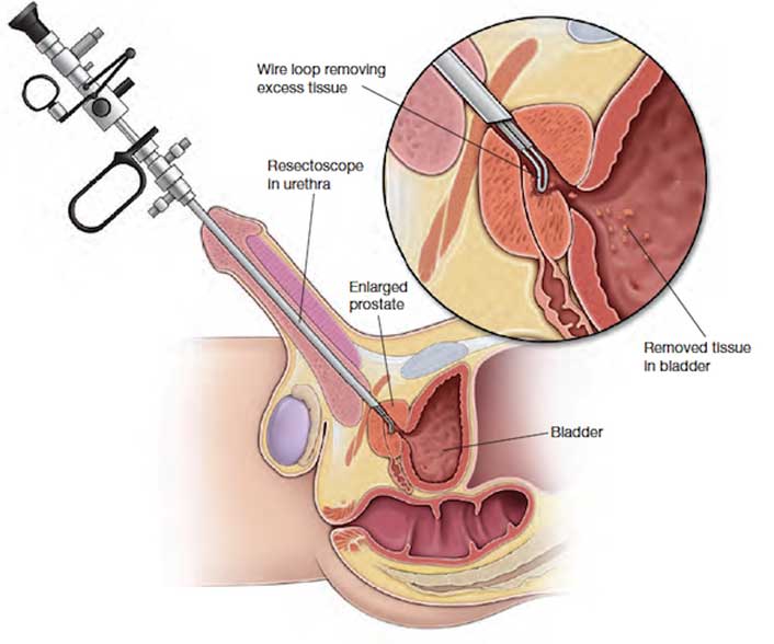 Enlarged Prostate Surgery TURP and Its Complication