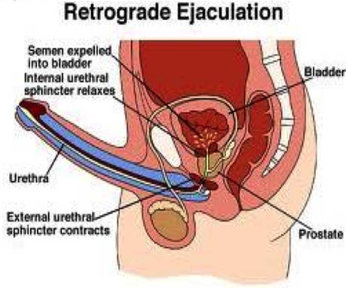 What does having an enlarged prostate mean