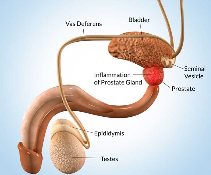 Tests and diagnosis of Enlarged Prostate (BPH)
