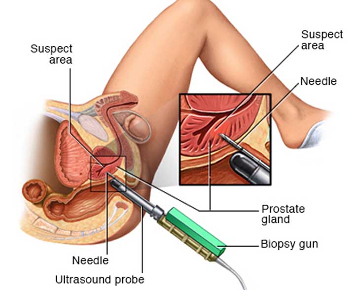 Prostate Gland Biopsy, Transrectal - Fine Needle - Core Biopsy