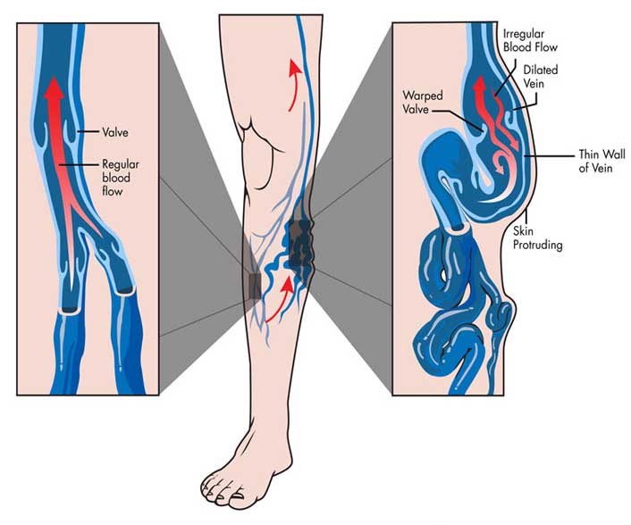 How Can Varicose Veins Be Prevented?