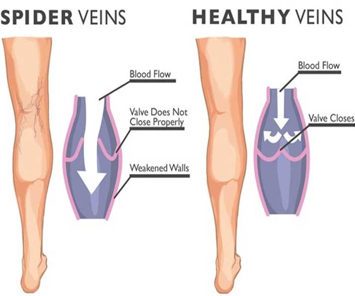 How can I prevent varicose veins and spider veins?