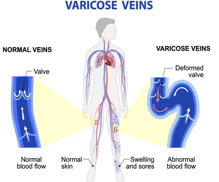 Symptoms of Varicose Veins & LatestTreatments: Delhi india