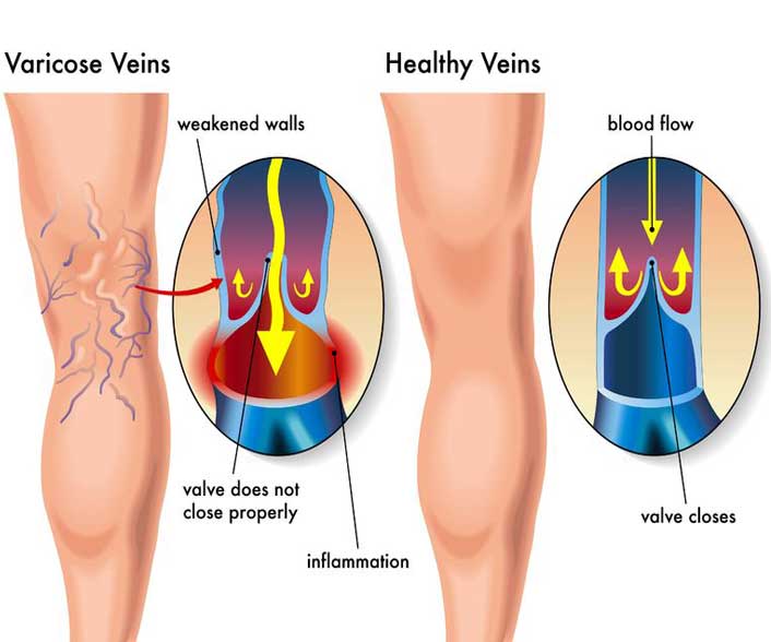 Varicose Vein in Pregnancy & latest treatment options without surgery