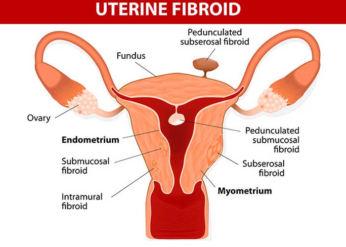 Suffering from Uterine Fibroids