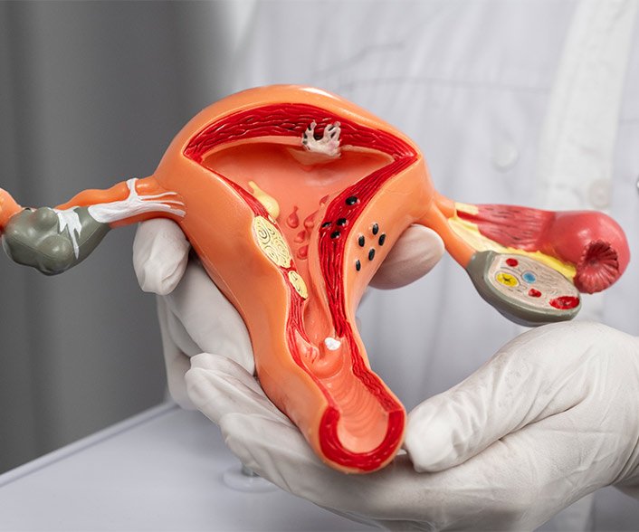 What is the cost of hysterectomy in Delhi?