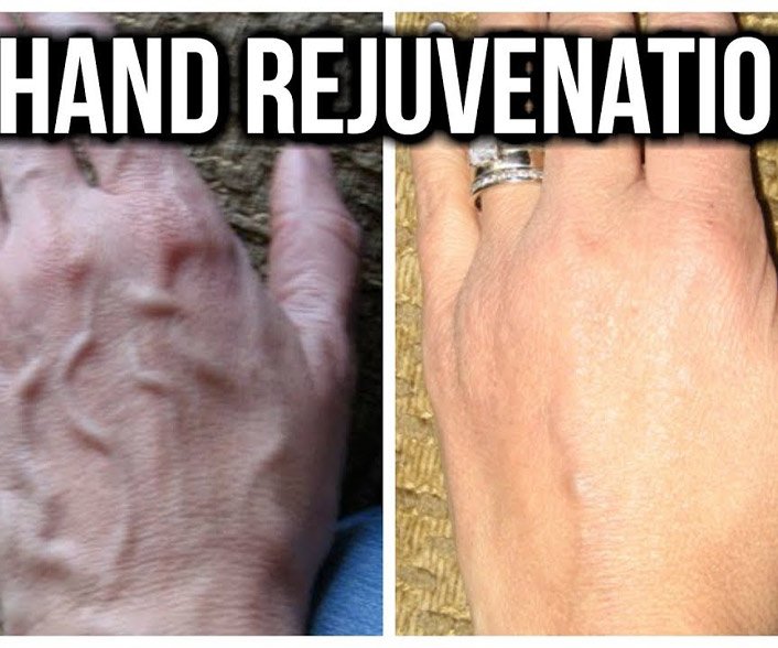 how to reduce veins in hands naturally