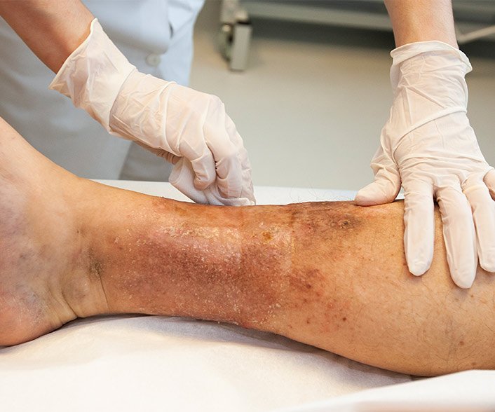 Varicose Veins Treatment Cost in Delhi