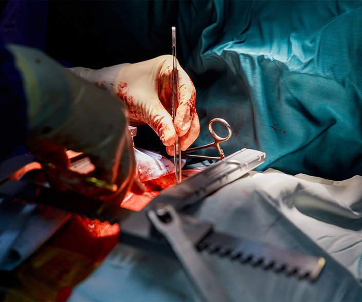 Hysterectomy Surgery Types & Recovery