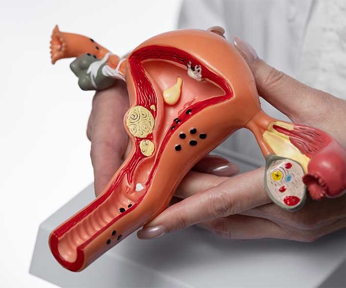 All You Need to Know About Adenomyosis: Key Insights into Symptoms, Causes and Treatment Options