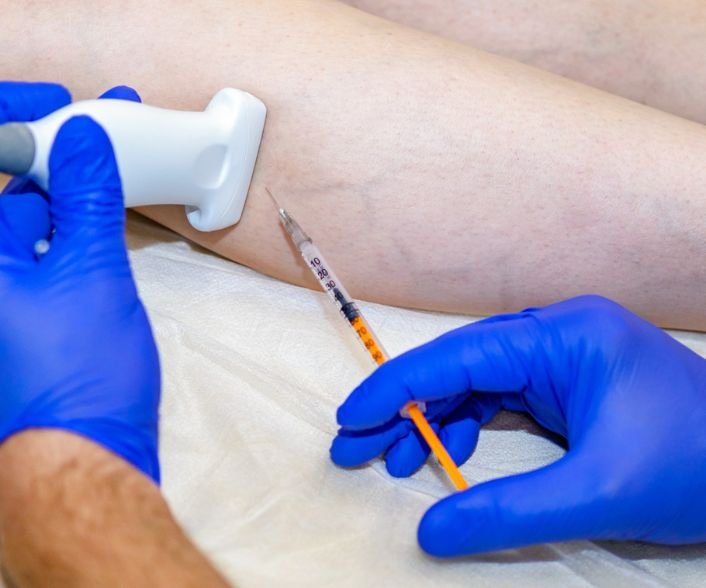 Varicose Veins Laser Treatment Cost In India | Sclerotherapy Cost