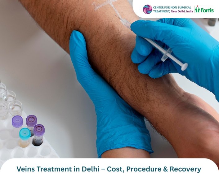 Veins Treatment in Delhi – Cost, Procedure & Recovery