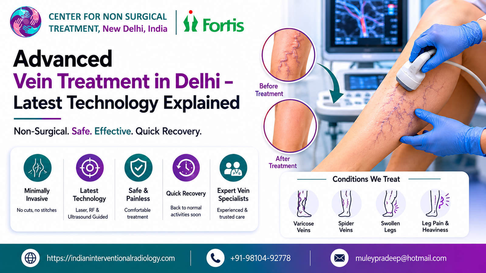 Advanced Vein Treatment in Delhi – Latest Technology Explained