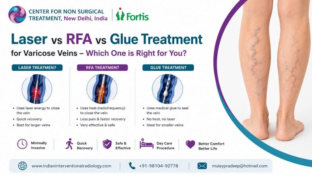Laser vs RFA vs Glue Treatment for Varicose Veins – Which One is Right for You?