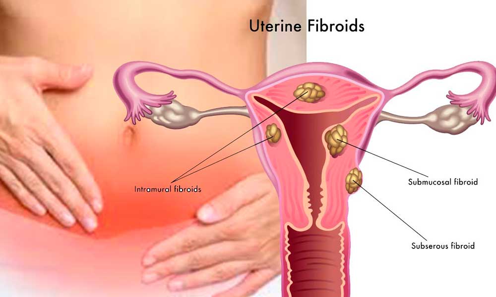 Uterine Fibroids after Menopause