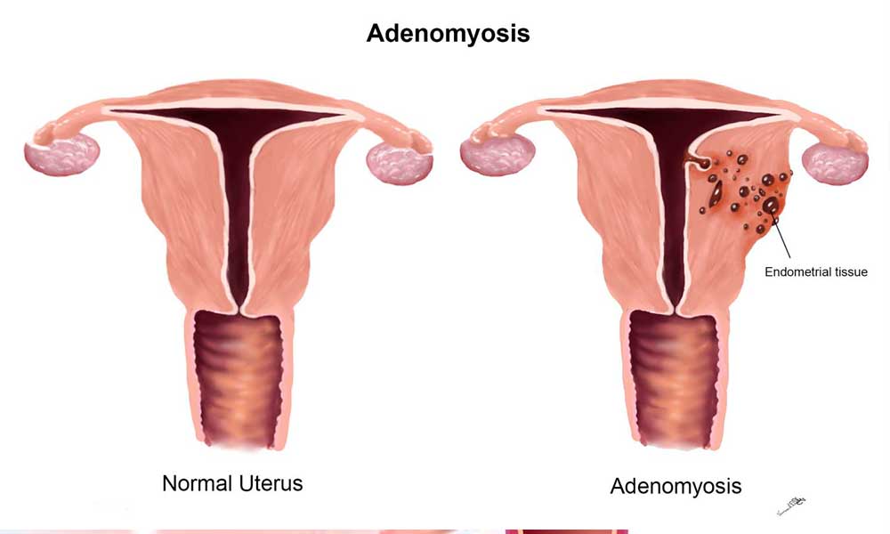 Endometriosis - Types, Symptoms, Causes and treatment