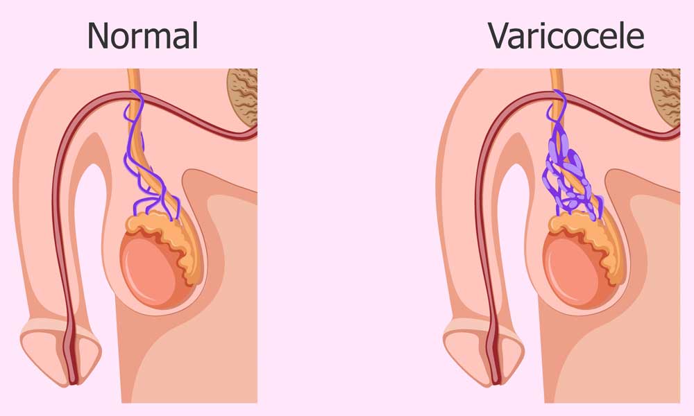 Varicocele embolization using image guidance