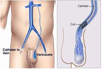 Varicocele Treatment - What is the Best Cure for Varicocele?