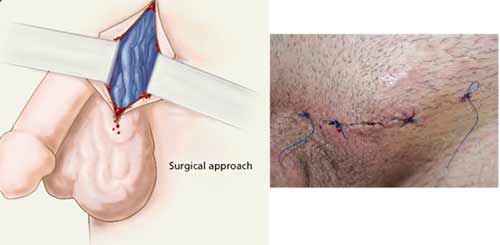 Non-surgical treatment for varicocele-embolization