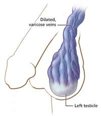 Testicular Varicocele Treatment Without Surgery - Varicocele Healing